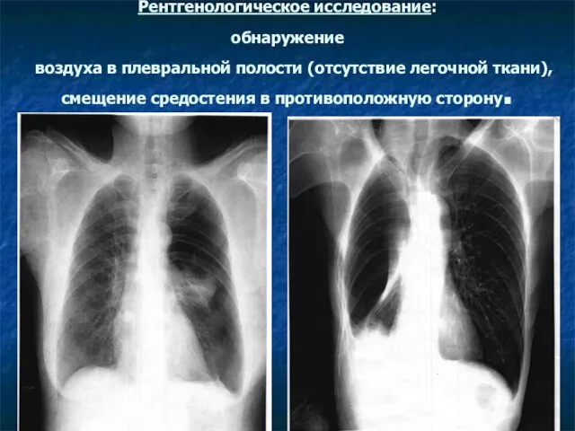 Рентгенологическое исследование: обнаружение воздуха в плевральной полости (отсутствие легочной ткани), смещение средостения в противоположную сторону.