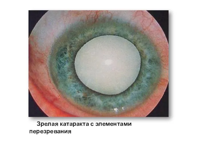 Зрелая катаракта с элементами перезревания