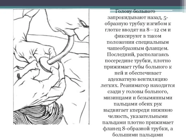 Голову больного запрокидывают назад, 5-образную трубку изгибом к глотке вводят на