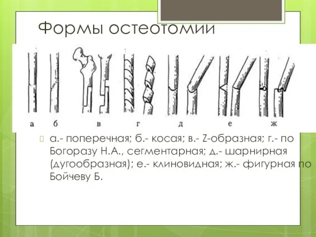 Формы остеотомии а.- поперечная; б.- косая; в.- Z-образная; г.- по Богоразу