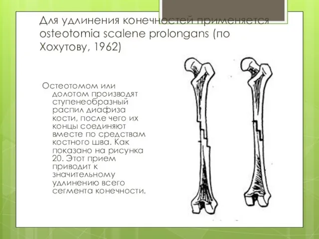 Для удлинения конечностей применяется osteotomia scalene prolongans (по Хохутову, 1962) Остеотомом