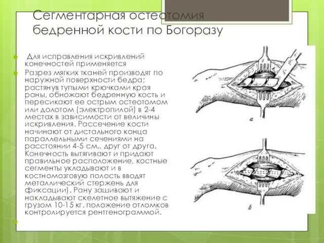 Сегментарная остеотомия бедренной кости по Богоразу Для исправления искривлений конечностей применяется