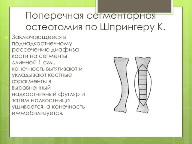 Поперечная сегментарная остеотомия по Шпрингеру К. Заключающееся в поднадкостнечному рассечению диафиза