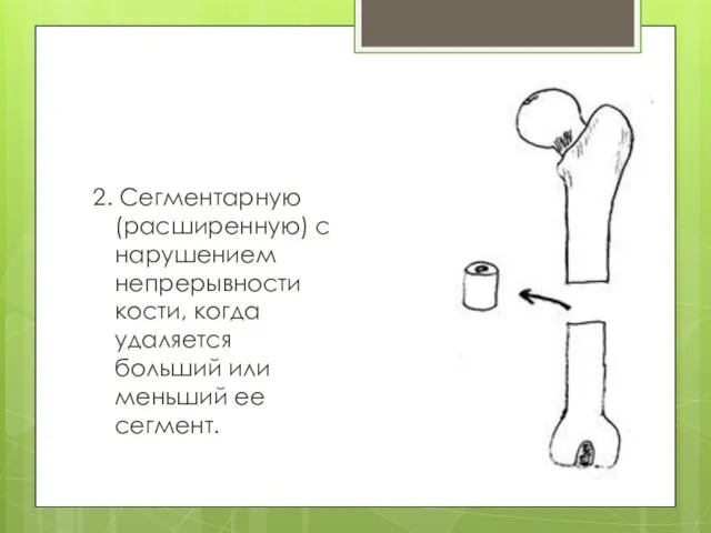 2. Сегментарную (расширенную) с нарушением непрерывности кости, когда удаляется больший или меньший ее сегмент.