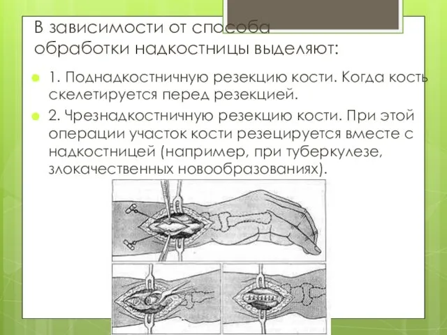 В зависимости от способа обработки надкостницы выделяют: 1. Поднадкостничную резекцию кости.