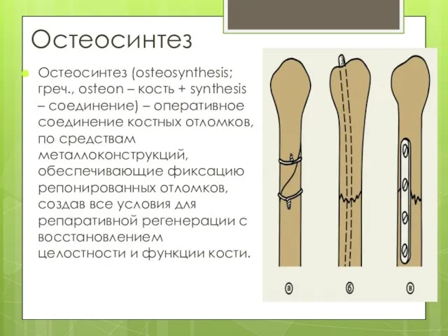 Остеосинтез Остеосинтез (osteosynthesis; греч., osteon – кость + synthesis – соединение)