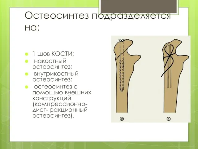 Остеосинтез подразделяется на: 1 шов КОСТИ; накостный остеосинтез; внутрикостный остеосинтез; остеосинтез