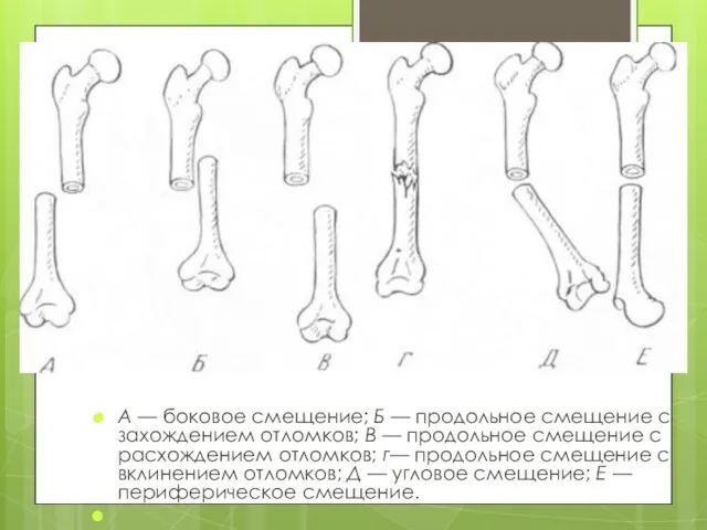 А — боковое смещение; Б — продольное смещение с захождением отломков;