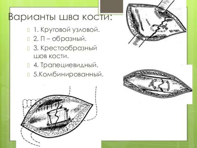 Варианты шва кости: 1. Круговой узловой. 2. П – образный. 3.