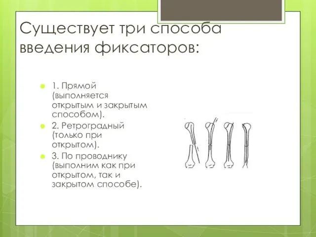 Существует три способа введения фиксаторов: 1. Прямой (выполняется открытым и закрытым