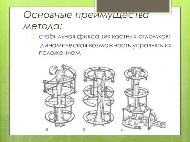 Основные преимущества метода: стабильная фиксация костных отломков; динамическая возможность управлять их положением