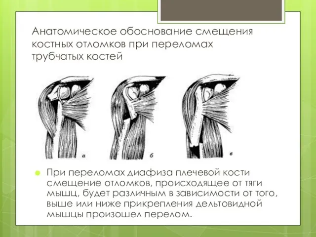 Анатомическое обоснование смещения костных отломков при переломах трубчатых костей При переломах