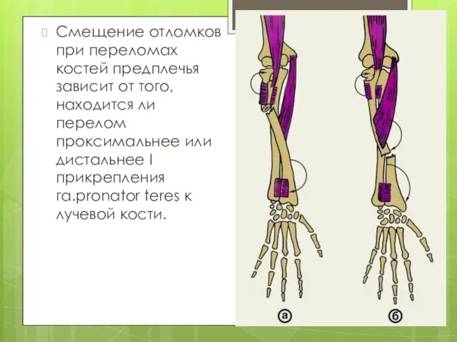 Смещение отломков при переломах костей предплечья зависит от того, находится ли