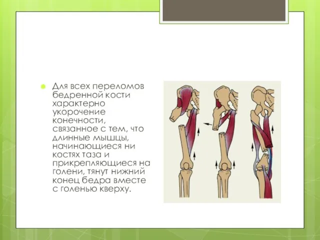 Для всех переломов бедренной кости характерно укорочение конечности, связанное с тем,
