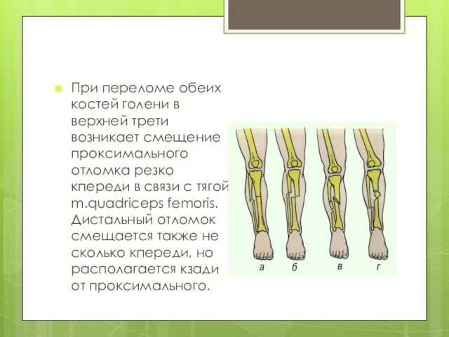 При переломе обеих костей голени в верхней трети возникает смещение проксимального