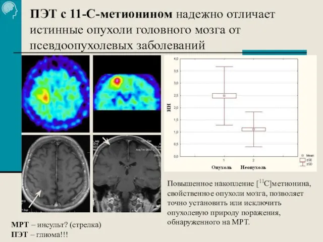 ПЭТ с 11-С-метионином надежно отличает истинные опухоли головного мозга от псевдоопухолевых