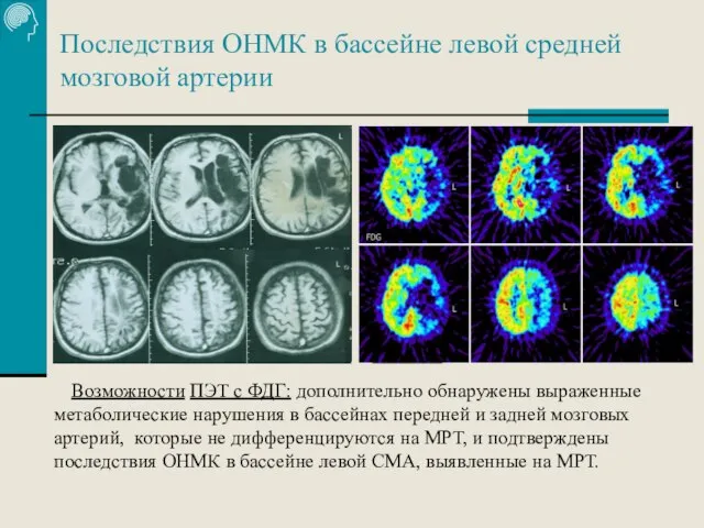 Последствия ОНМК в бассейне левой средней мозговой артерии Возможности ПЭТ с