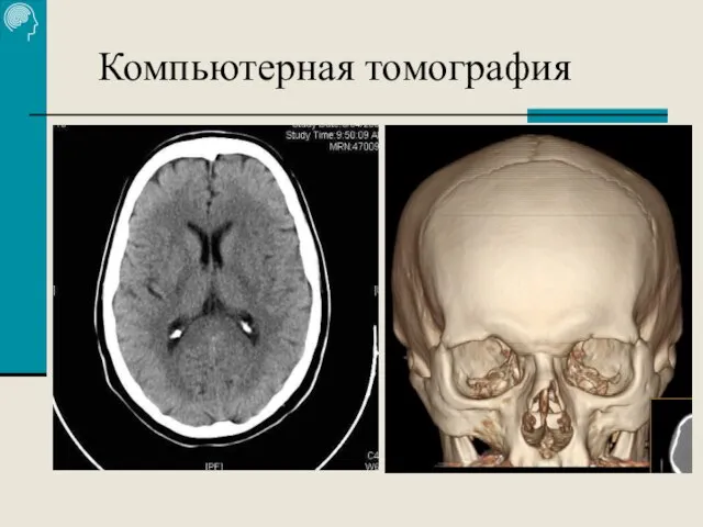 Компьютерная томография