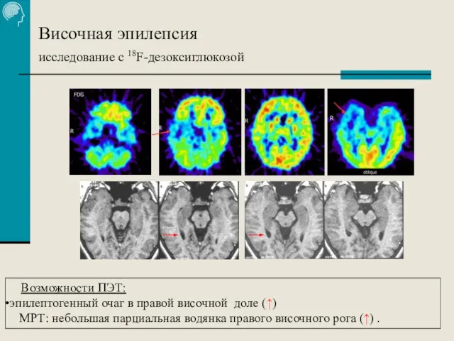 Височная эпилепсия исследование с 18F-дезоксиглюкозой Возможности ПЭТ: эпилептогенный очаг в правой