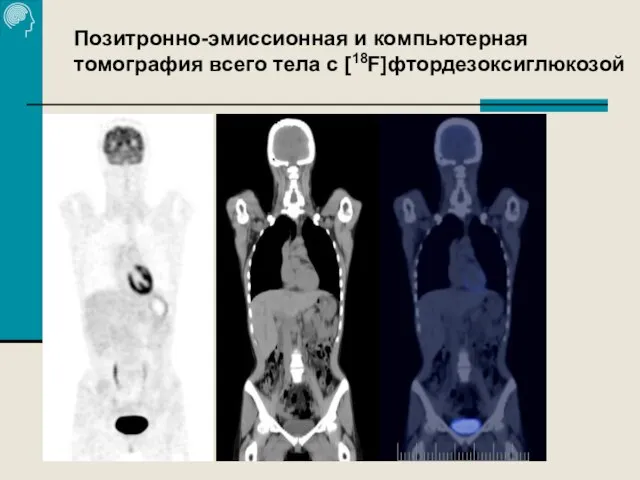 Позитронно-эмиссионная и компьютерная томография всего тела с [18F]фтордезоксиглюкозой