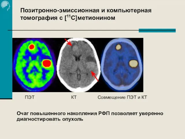 Позитронно-эмиссионная и компьютерная томография с [11С]метионином ПЭТ КТ Совмещение ПЭТ и