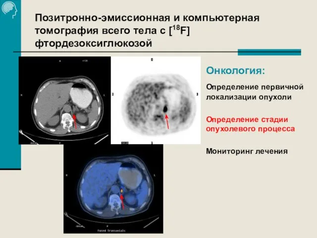 Позитронно-эмиссионная и компьютерная томография всего тела с [18F]фтордезоксиглюкозой Онкология: Определение первичной