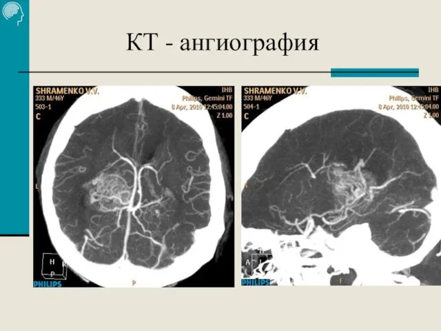 КТ - ангиография