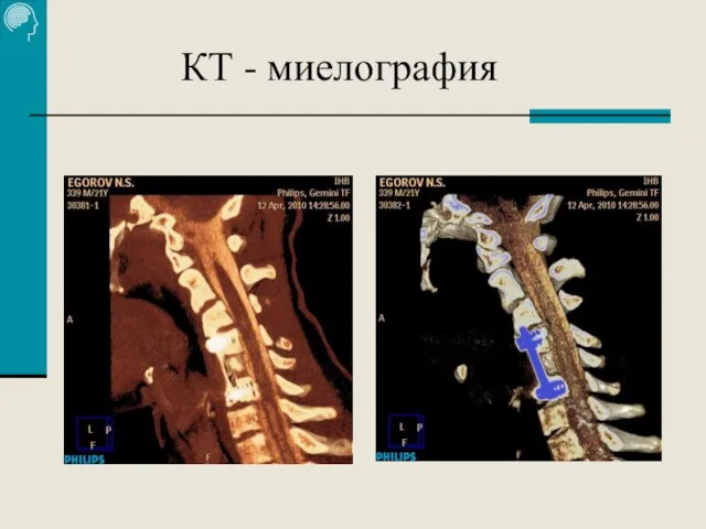 КТ - миелография