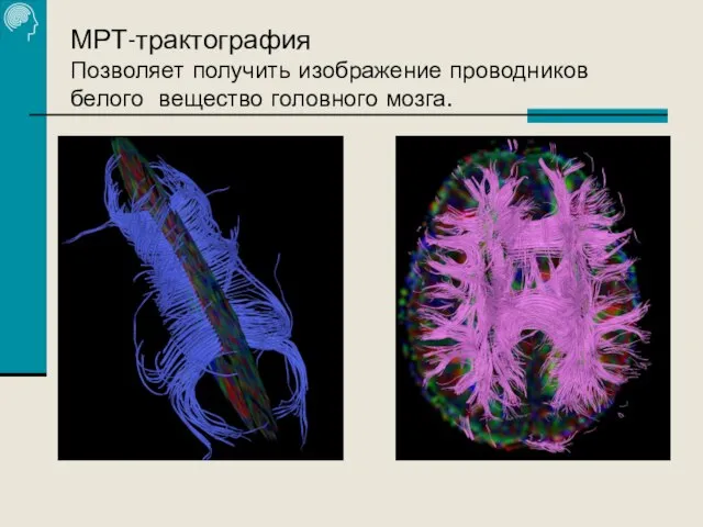 МРТ-трактография Позволяет получить изображение проводников белого вещество головного мозга.
