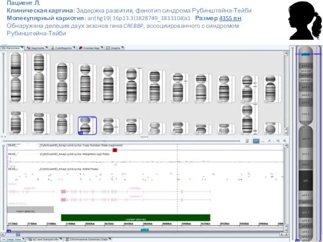 Пациент Л. Клиническая картина: Задержка развития, фенотип синдрома Рубинштейна-Тейби Молекулярный кариотип: