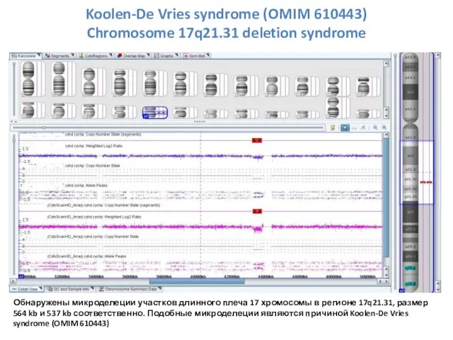 Обнаружены микроделеции участков длинного плеча 17 хромосомы в регионе 17q21.31, размер