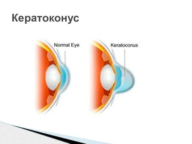 Кератоконус