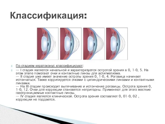 По стадиям кератоконус классифицируют: — I стадия является начальной и характеризуется