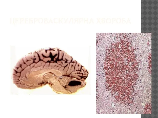 ЦЕРЕБРОВАСКУЛЯРНА ХВОРОБА