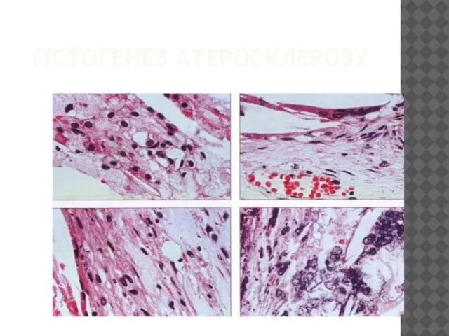 ГІСТОГЕНЕЗ АТЕРОСКЛЕРОЗУ