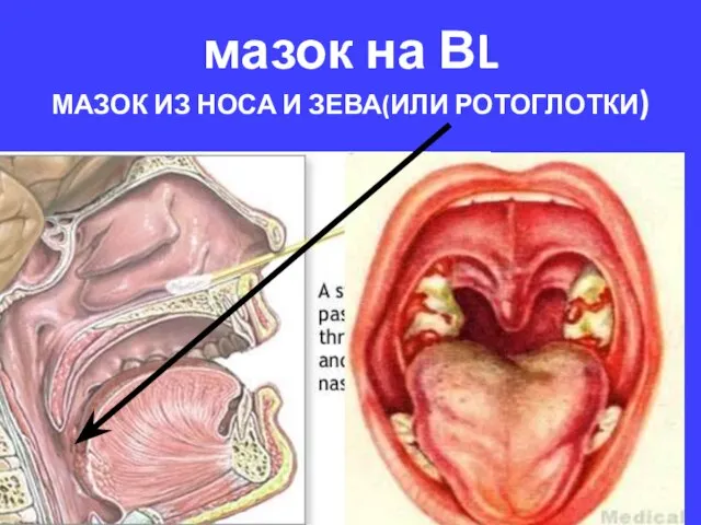 мазок на ВL МАЗОК ИЗ НОСА И ЗЕВА(ИЛИ РОТОГЛОТКИ)