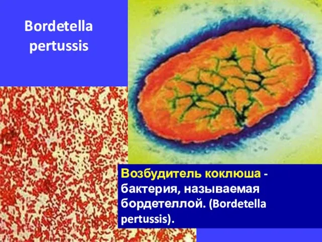 Bordetella pertussis Возбудитель коклюша - бактерия, называемая бордетеллой. (Bordetella pertussis).