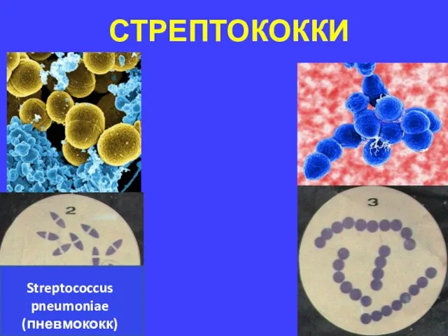 СТРЕПТОКОККИ Streptococcus pneumoniae (пневмококк)