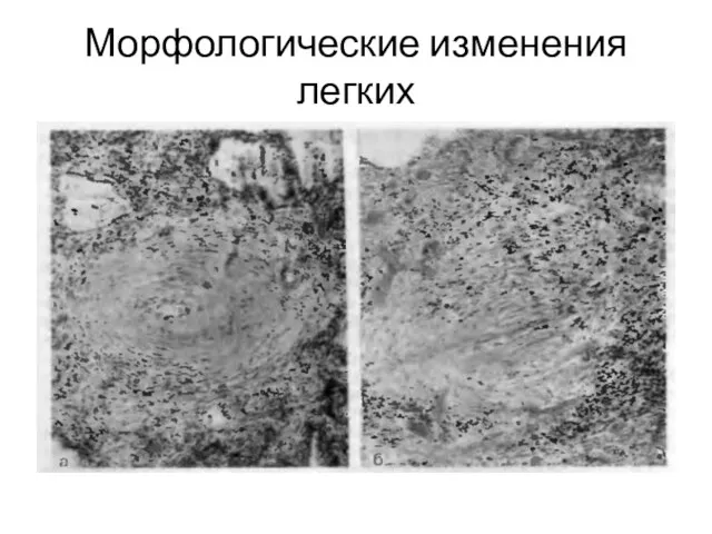 Морфологические изменения легких