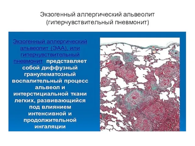 Экзогенный аллергический альвеолит (гиперчувствительный пневмонит)