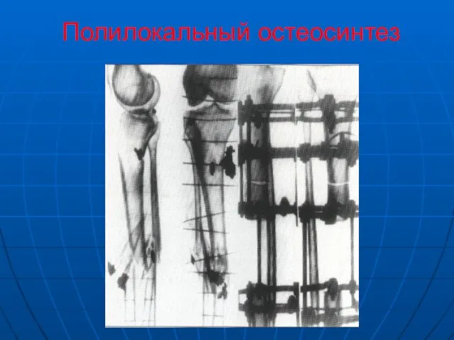 Полилокальный остеосинтез