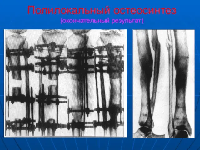 Полилокальный остеосинтез (окончательный результат)