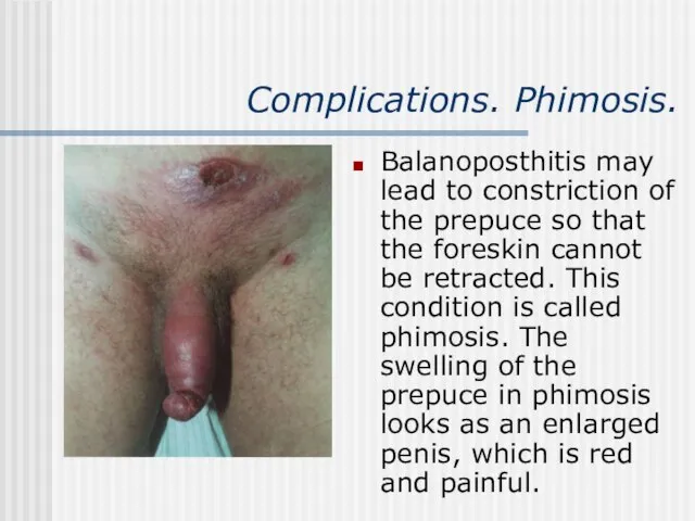Complications. Phimosis. Balanoposthitis may lead to constriction of the prepuce so