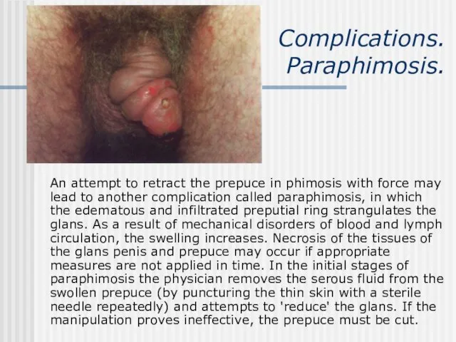 Complications. Paraphimosis. An attempt to retract the prepuce in phimosis with