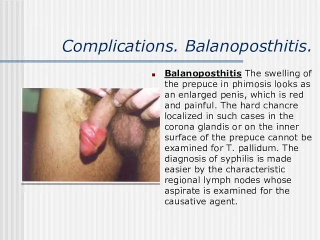 Complications. Balanoposthitis. Balanoposthitis The swelling of the prepuce in phimosis looks