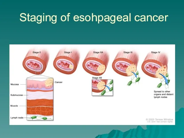 Staging of esohpageal cancer