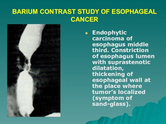 BARIUM CONTRAST STUDY OF ESOPHAGEAL CANCER Endophytic carcinoma of esophagus middle