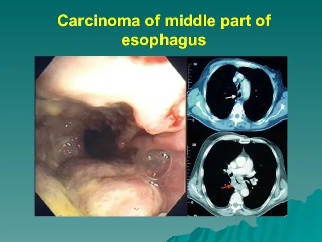 Carcinoma of middle part of esophagus