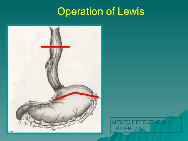 МЕСТО ПЕРЕСЕЧЕНИЯ ПИЩЕВОДА. Operation of Lewis