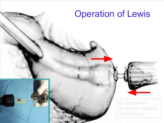 Operation of Lewis Соединение съемной головки и степлера.